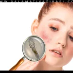 علل کنه صورت چیست؟