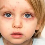 تعبیر خواب دانه روی صورت برای زن متاهل و باردار و دختر مجرد از روانشناسی