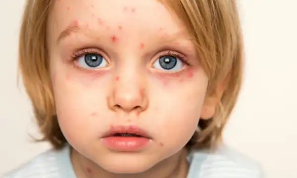 تعبیر خواب دانه روی صورت برای زن متاهل و باردار و دختر مجرد از روانشناسی