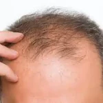 تعبیر خواب طاس شدن جلوی سر برای زن متاهل و باردار و دختر مجرد از روانشناسی