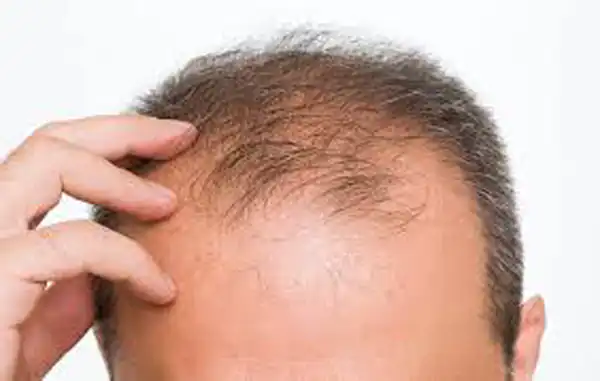 تعبیر خواب طاس شدن جلوی سر برای زن متاهل و باردار و دختر مجرد از روانشناسی