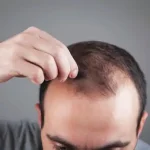 تعبیر خواب طاس شدن سر مرد برای زن متاهل و باردار و دختر مجرد از روانشناسی