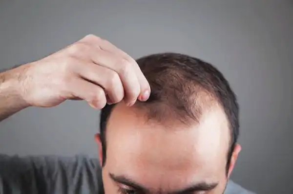 تعبیر خواب طاس شدن سر مرد برای زن متاهل و باردار و دختر مجرد از روانشناسی