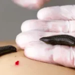 تعبیر خواب زالو چیست برای زن متاهل و باردار و دختر مجرد از روانشناسی