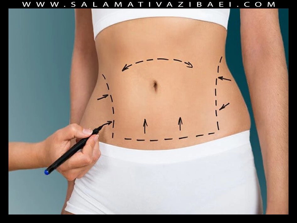 لاغری با میکرو ایر لیپوساکشن