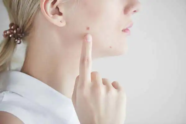 تعبیر خواب خال صورت برای زن متاهل و باردار و دختر مجرد از روانشناسی