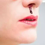 تعبیر خواب خون دماغ شدن خودم برای زن متاهل و باردار و دختر مجرد از روانشناسی