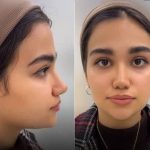 توصیه های طلایی دکتر علی شفیعی درباره ی مراقبت بعد از جراحی بینی