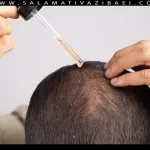 مضرات استفاده از ماینوکسیدیل – salamativazibaei
